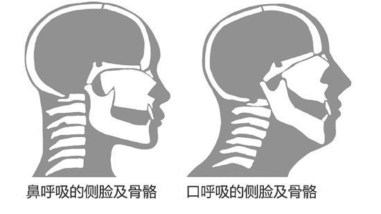 可怕：鼻炎会导致“毁容”！